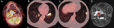 Frontiers Case Report Immunotherapy For Low Grade Myofibroblastic